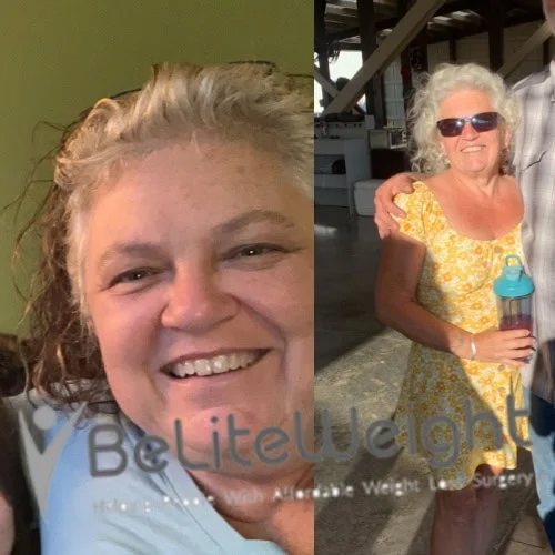 Weight Loss Surgery Before And After